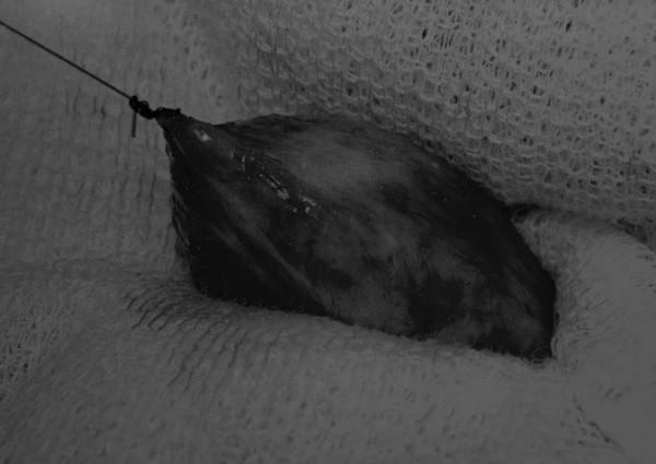 膀胱切开术手术方法与操作流程详解