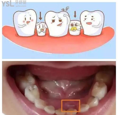儿童大牙更替全攻略：时机把握与口腔保健指南
